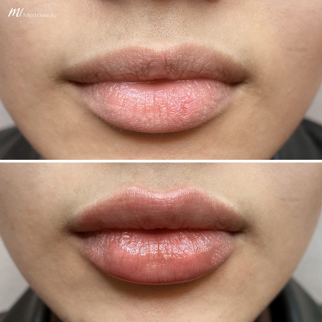 lip filler before after 4