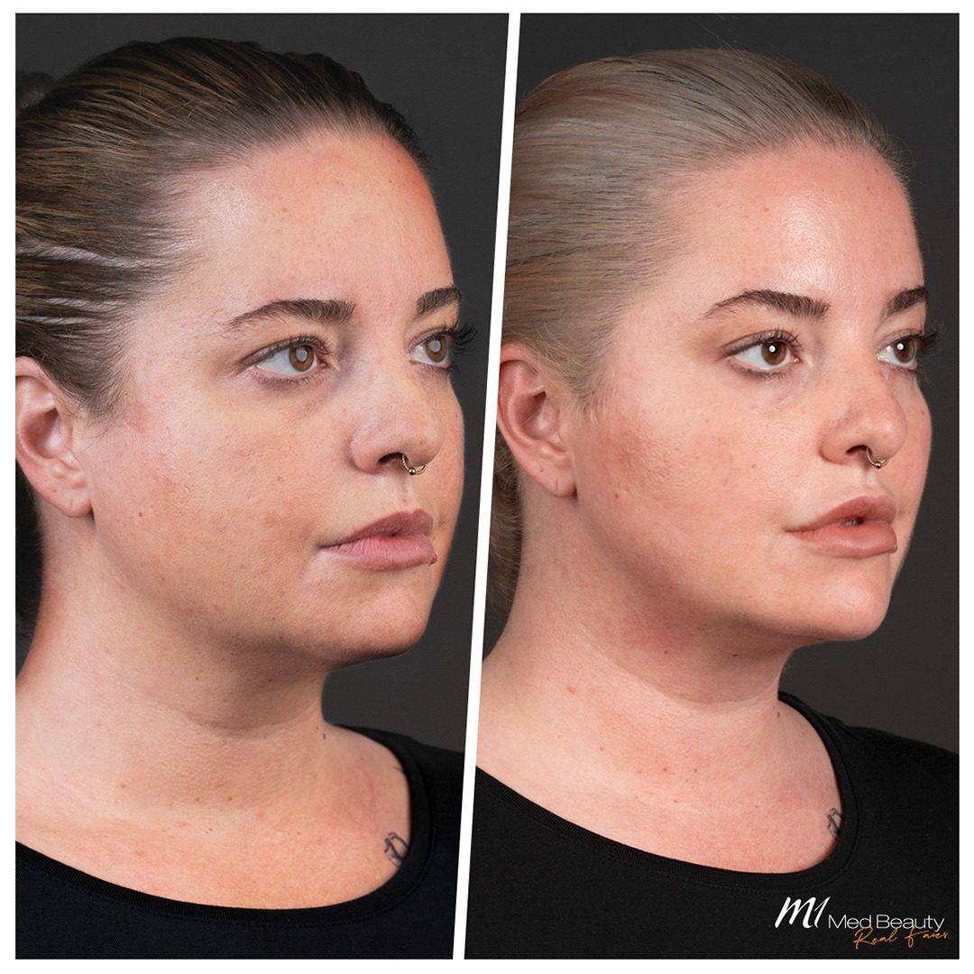 chin-filler-before-after-2