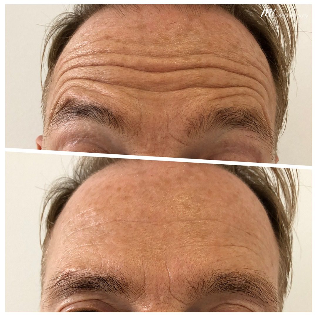 forehead-lines-treatment-before-after-1
