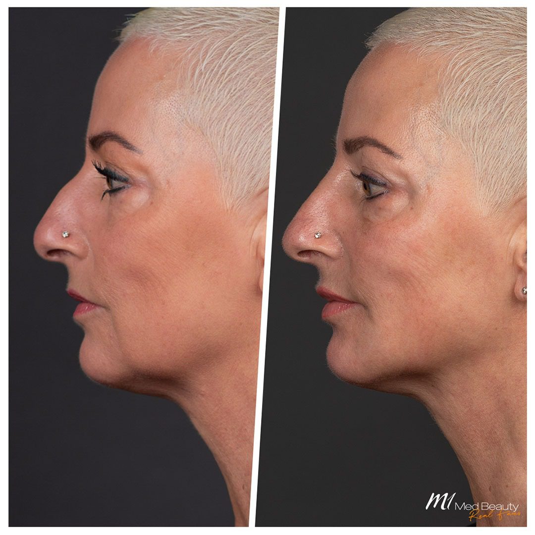 Marrionette Line filler treatment at M1 Med Beauty