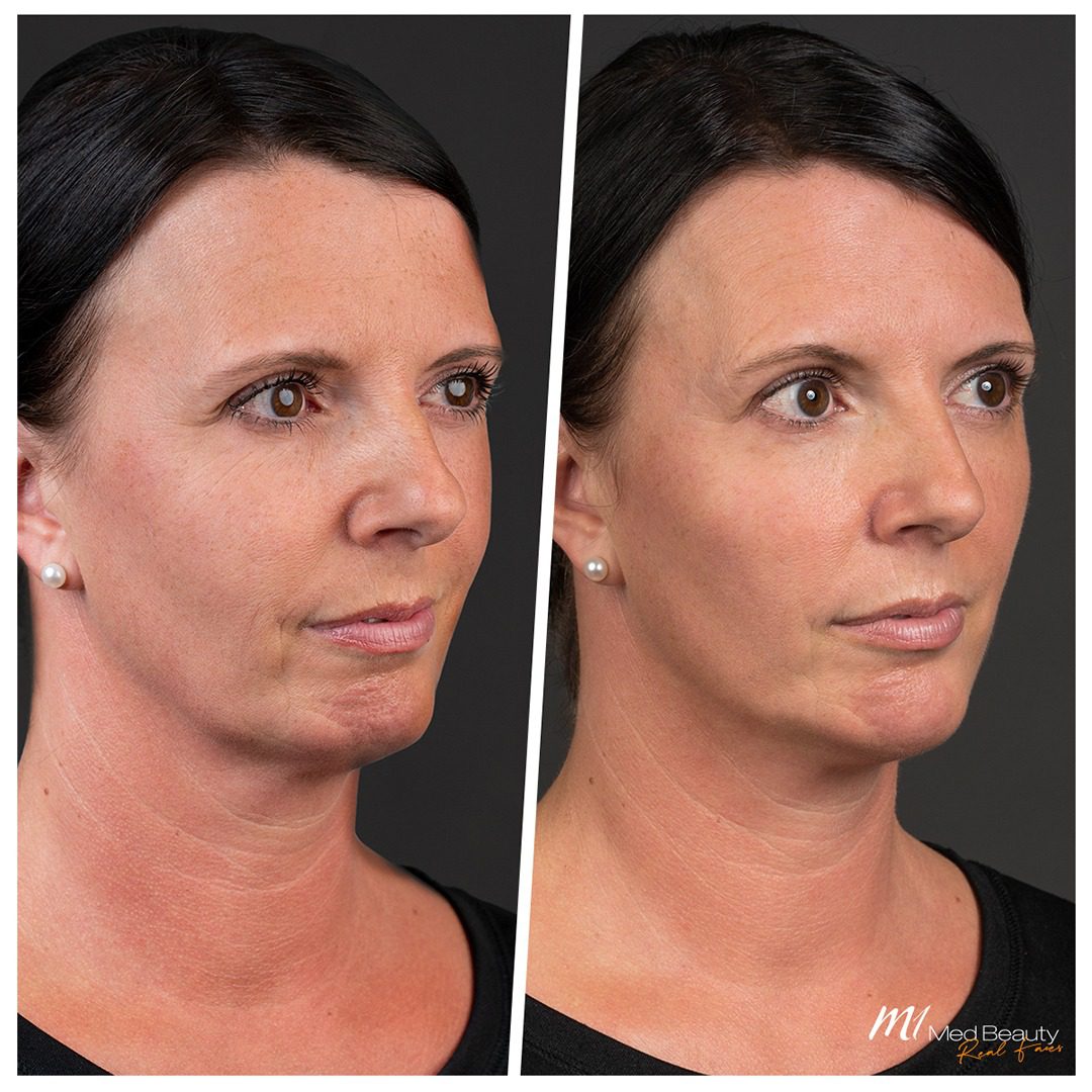 non-surgical rhinoplasty before after 11