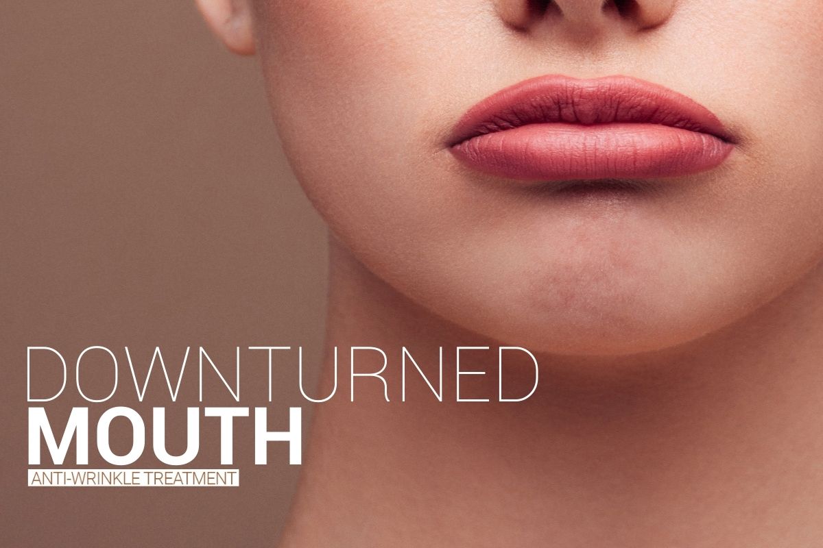 Downturned Mouth with Anti-Wrinkle Treatment