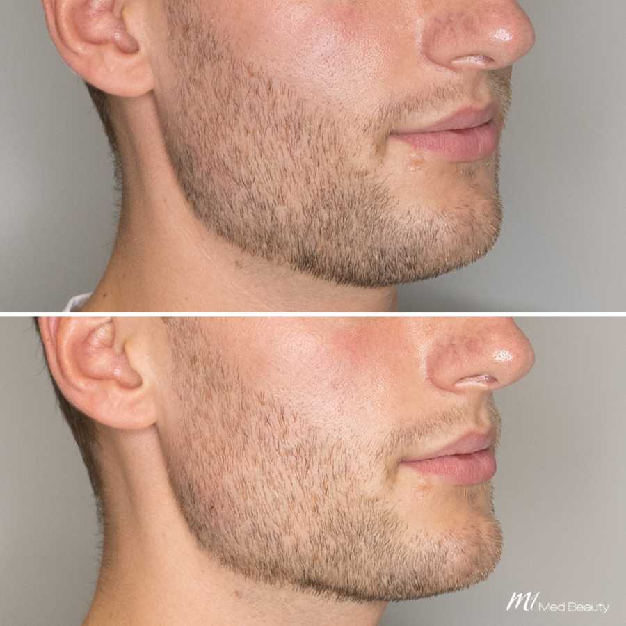 jawlinebefore-after 7