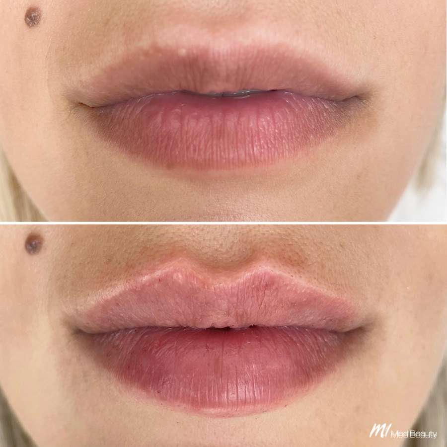 lips-before-after-12