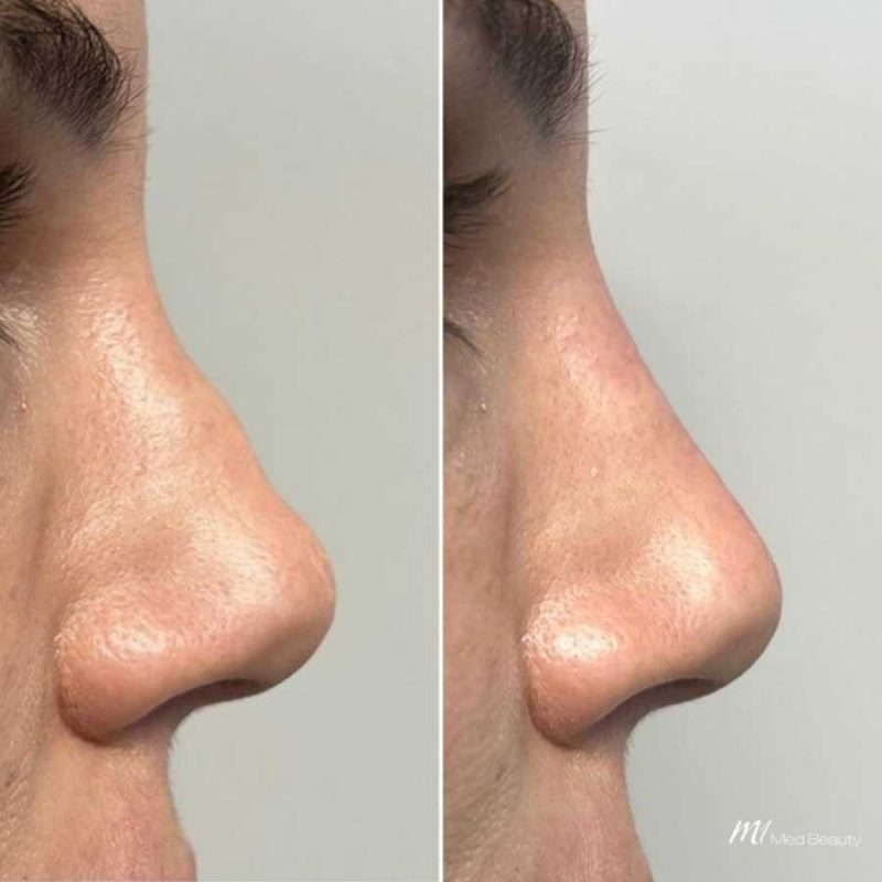 nose-before-after 2