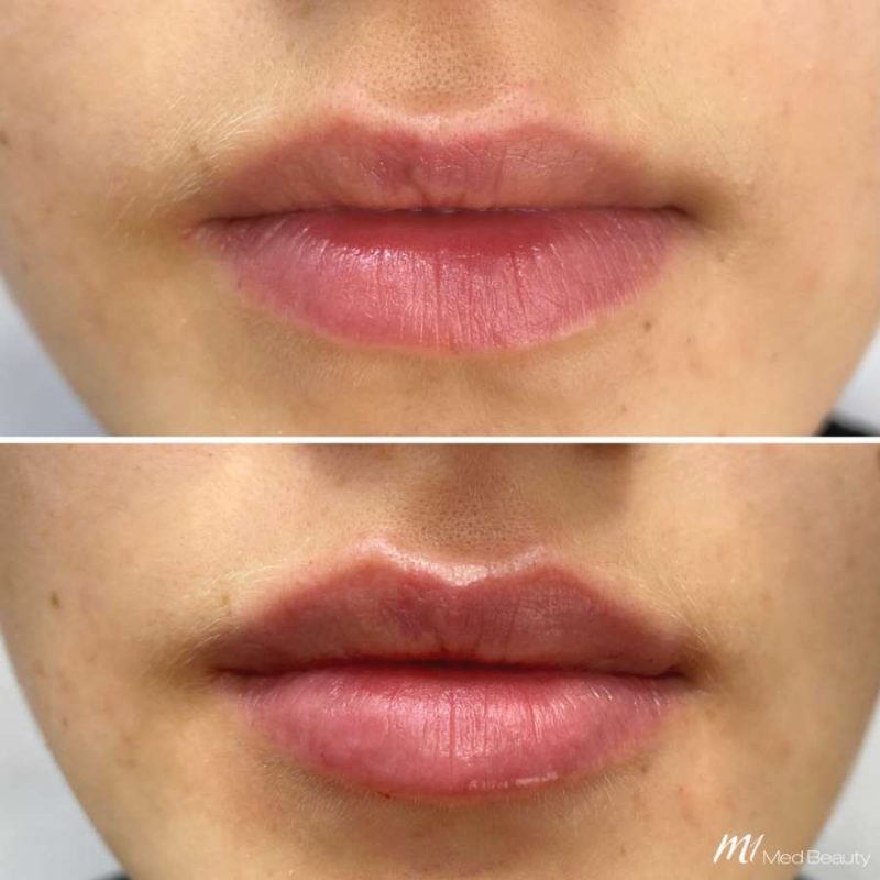 lips-before-after-14