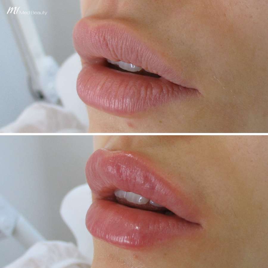lips-before-after-15