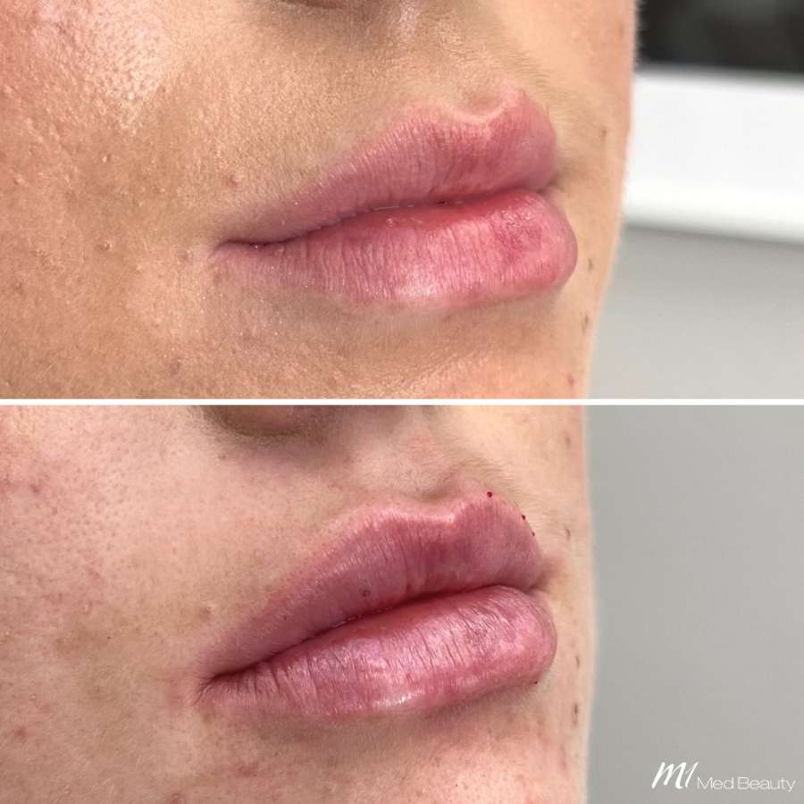 lips-before-after-16