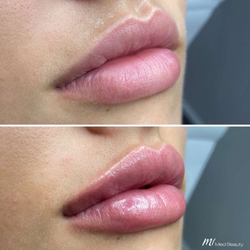 lips-before-after-17