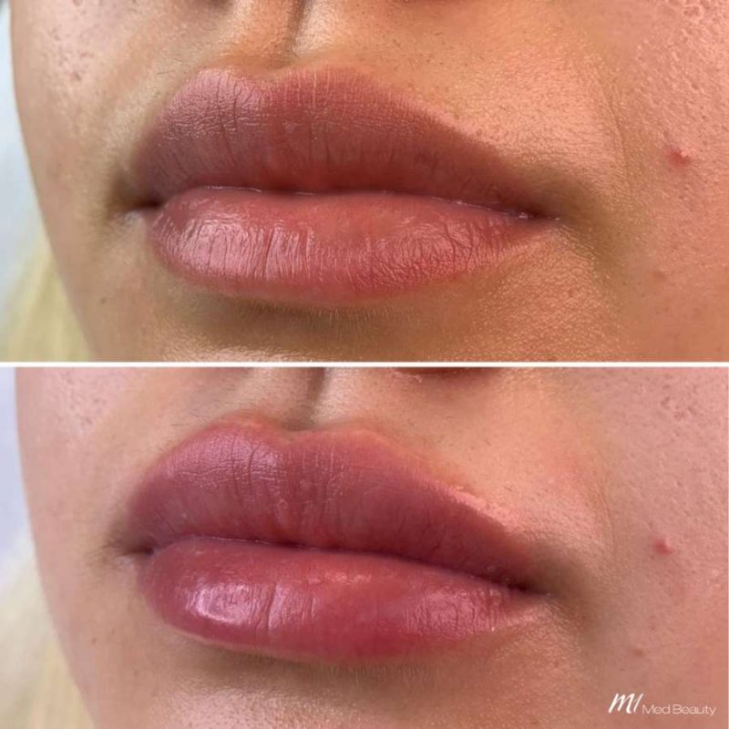 lips-before-after-18
