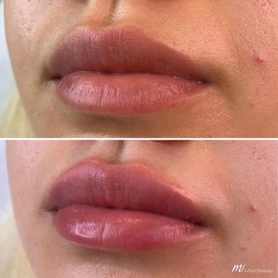 lips-before-after-18