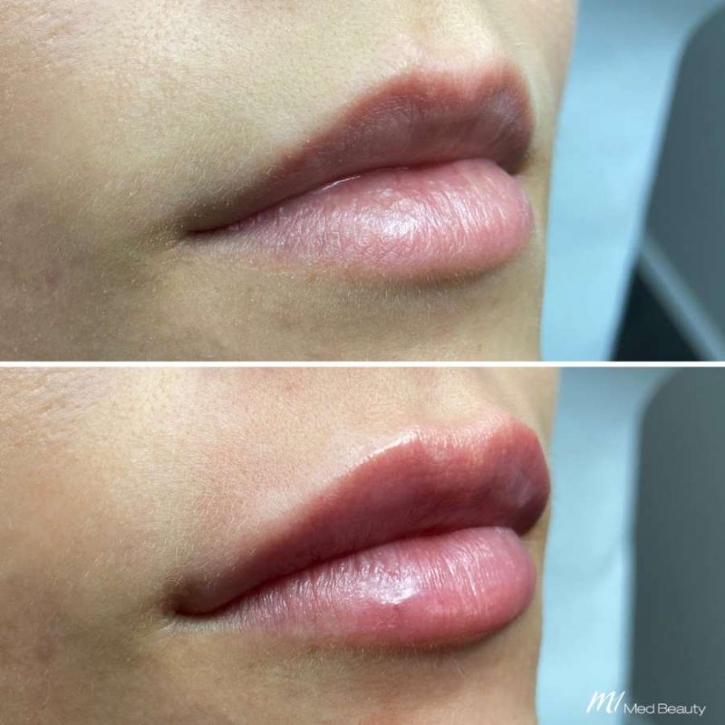 lips-before-after-19