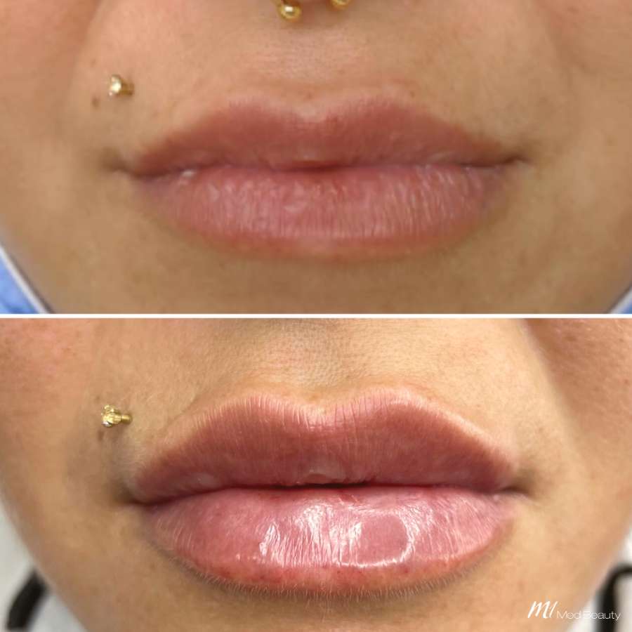 lips-before-after-20