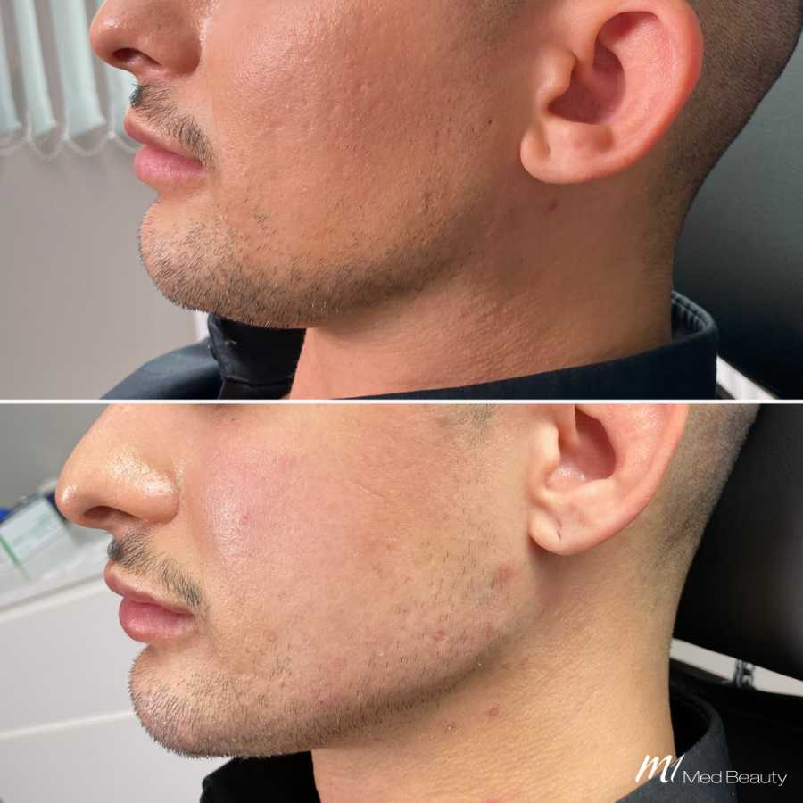 jawlinebefore-after 1