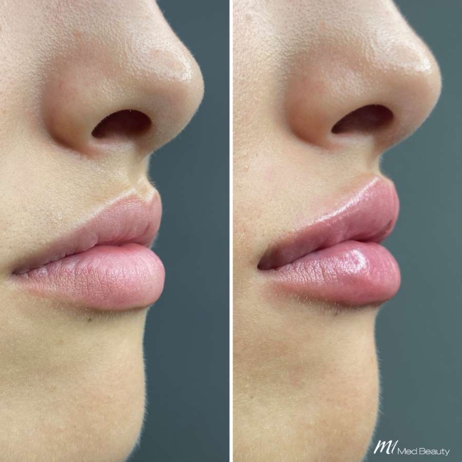 lips-before-after-22