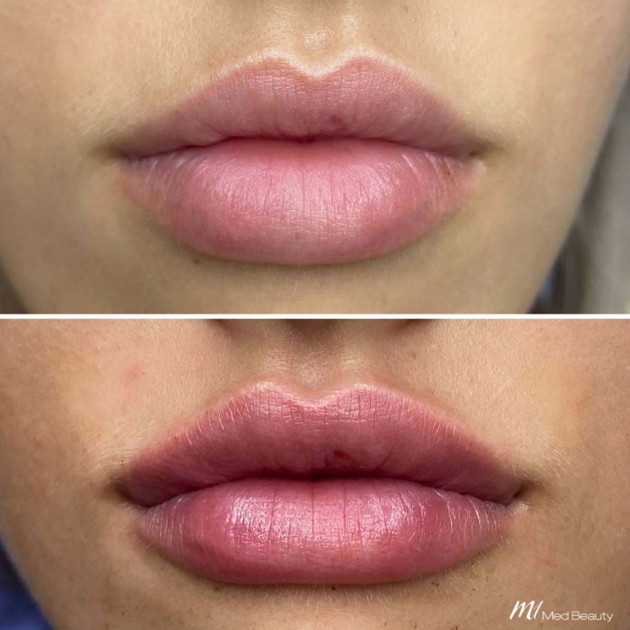 lips-before-after-23