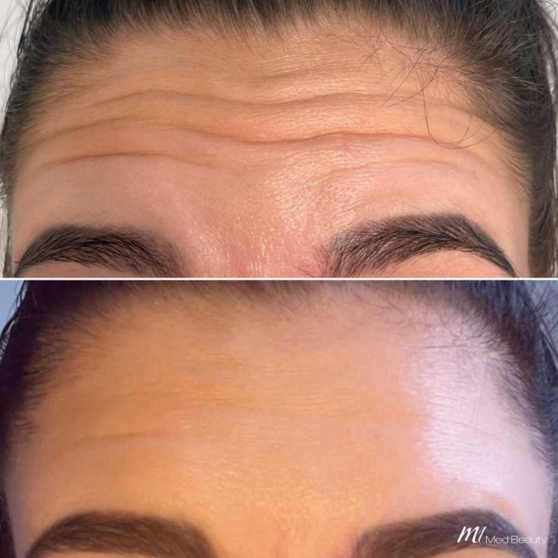 forehead-lines-before-after-1