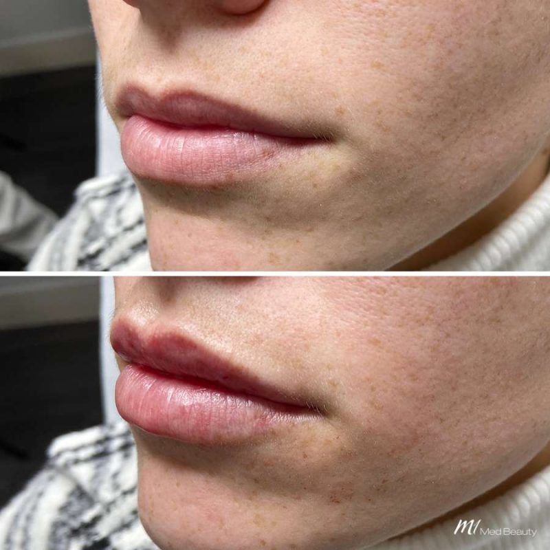 lips-before-after-4