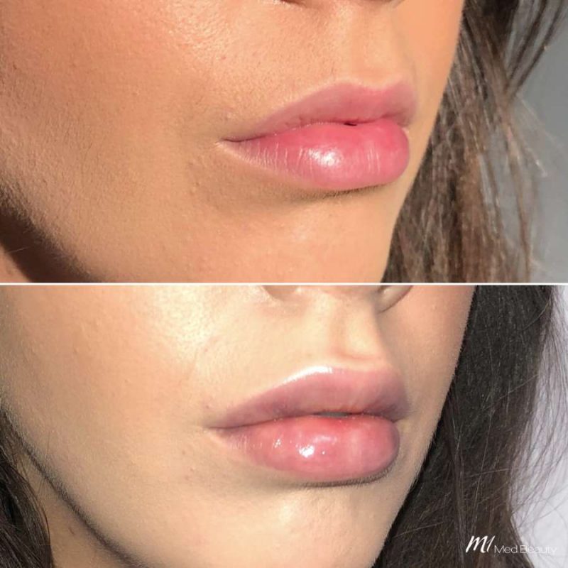 lips-before-after-5