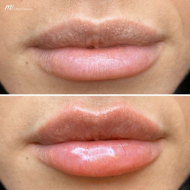 lips-before-after-8