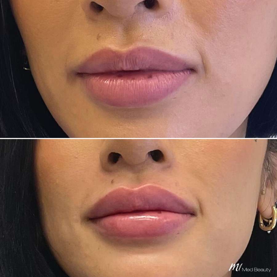 lips-before-after-9