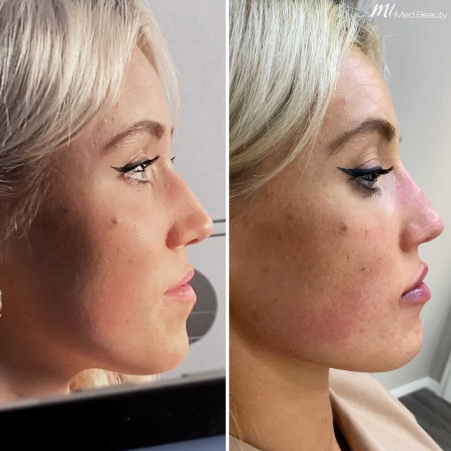 jawline-nose-before-after 6