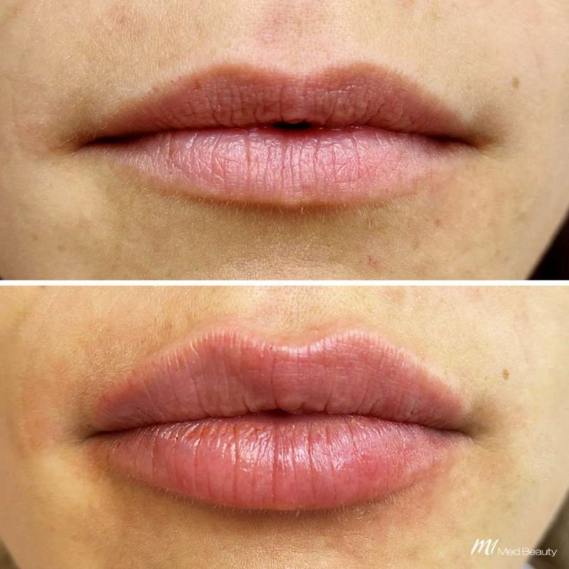 lips-before-after-10