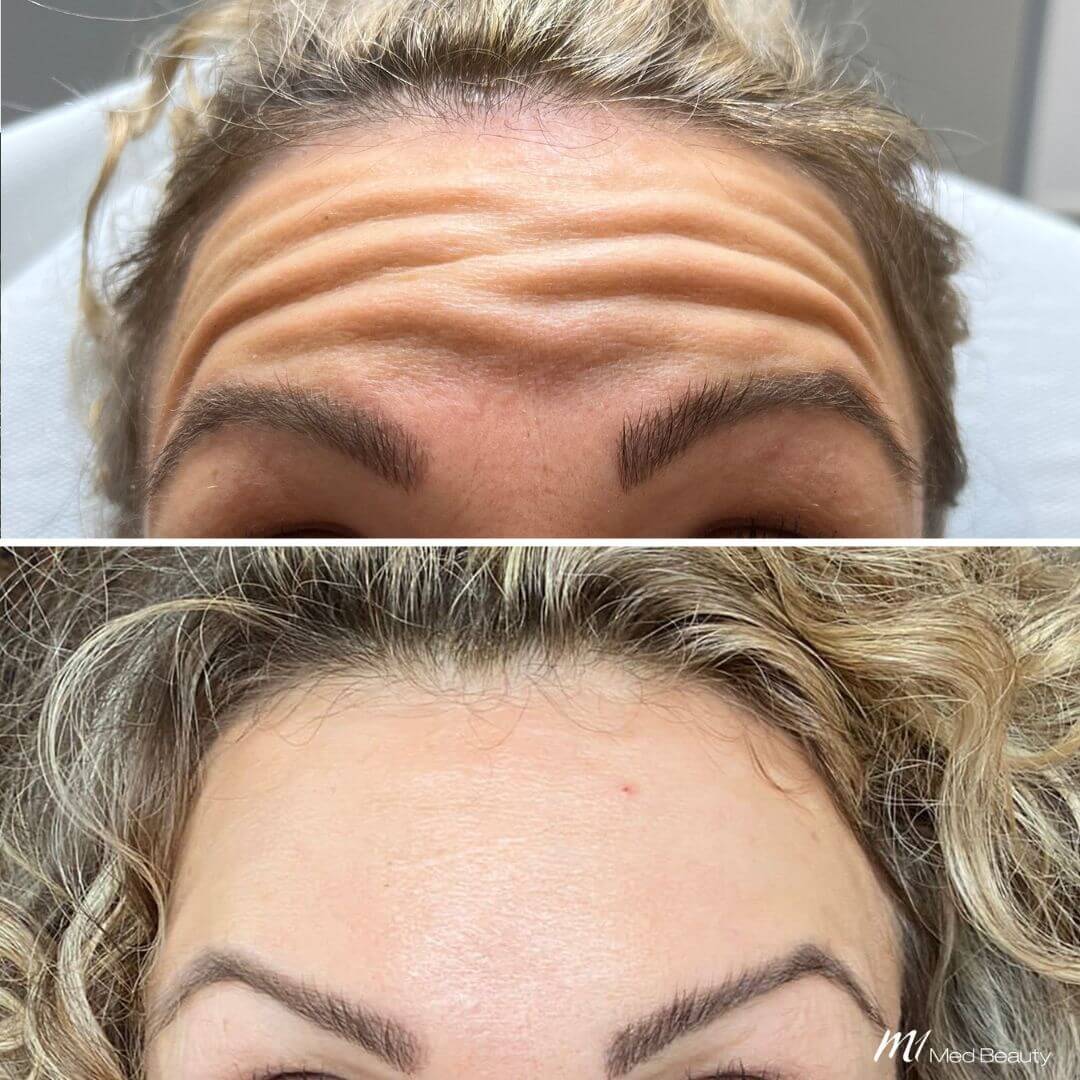 Anti-Wrinkle M1 Beauty (4)