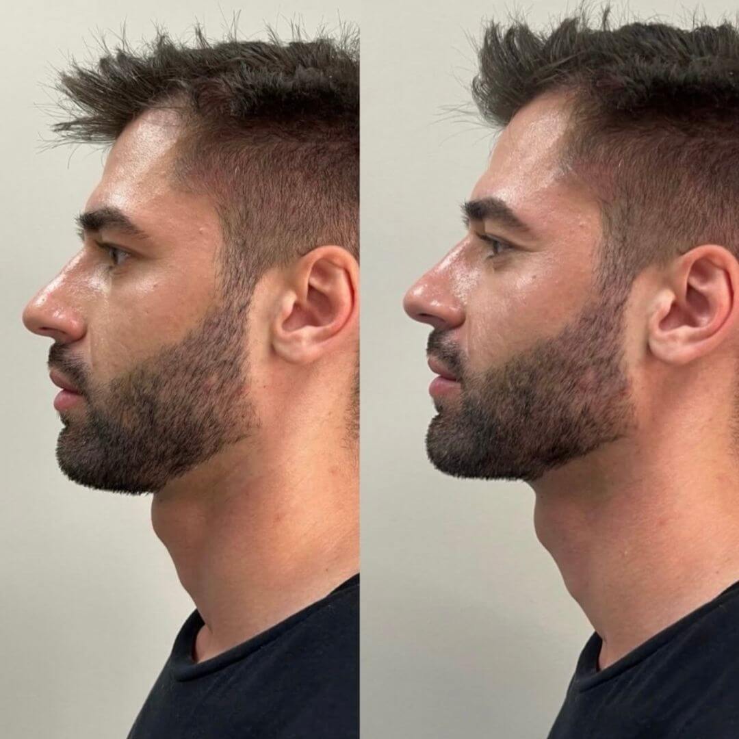 Chin (6)