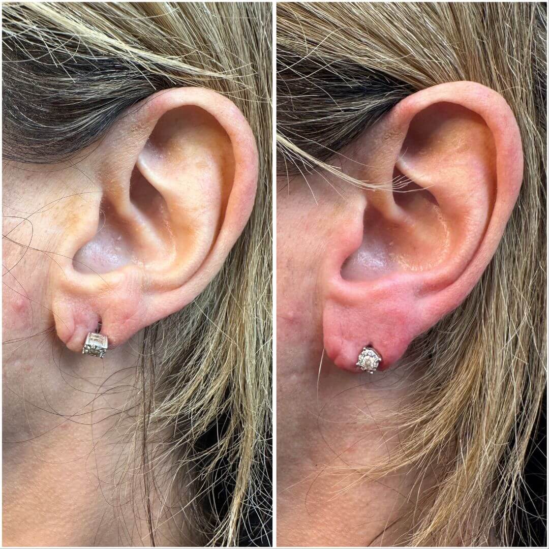 Dermal Filler M1 Beauty (6)