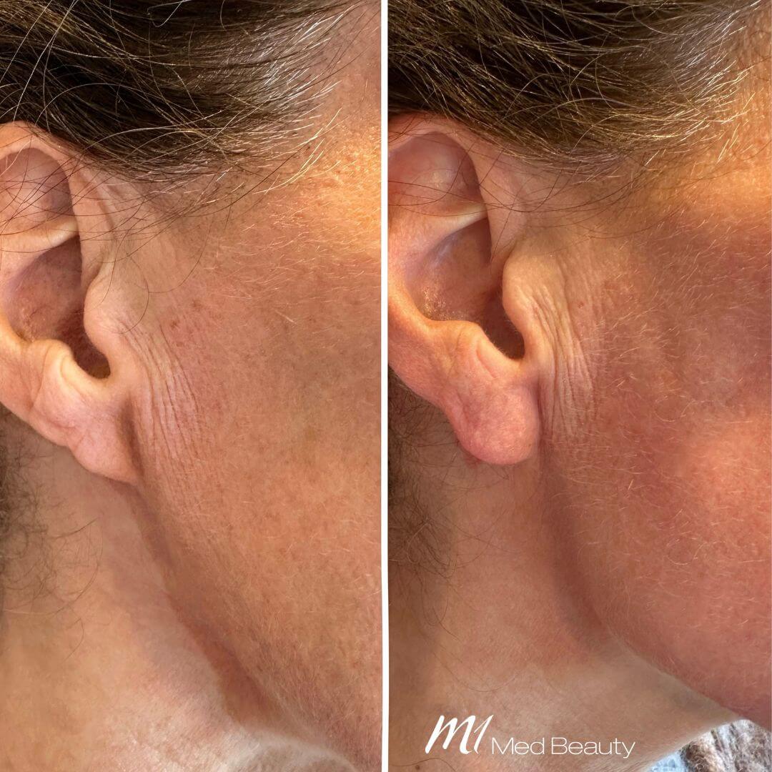 Earlobes