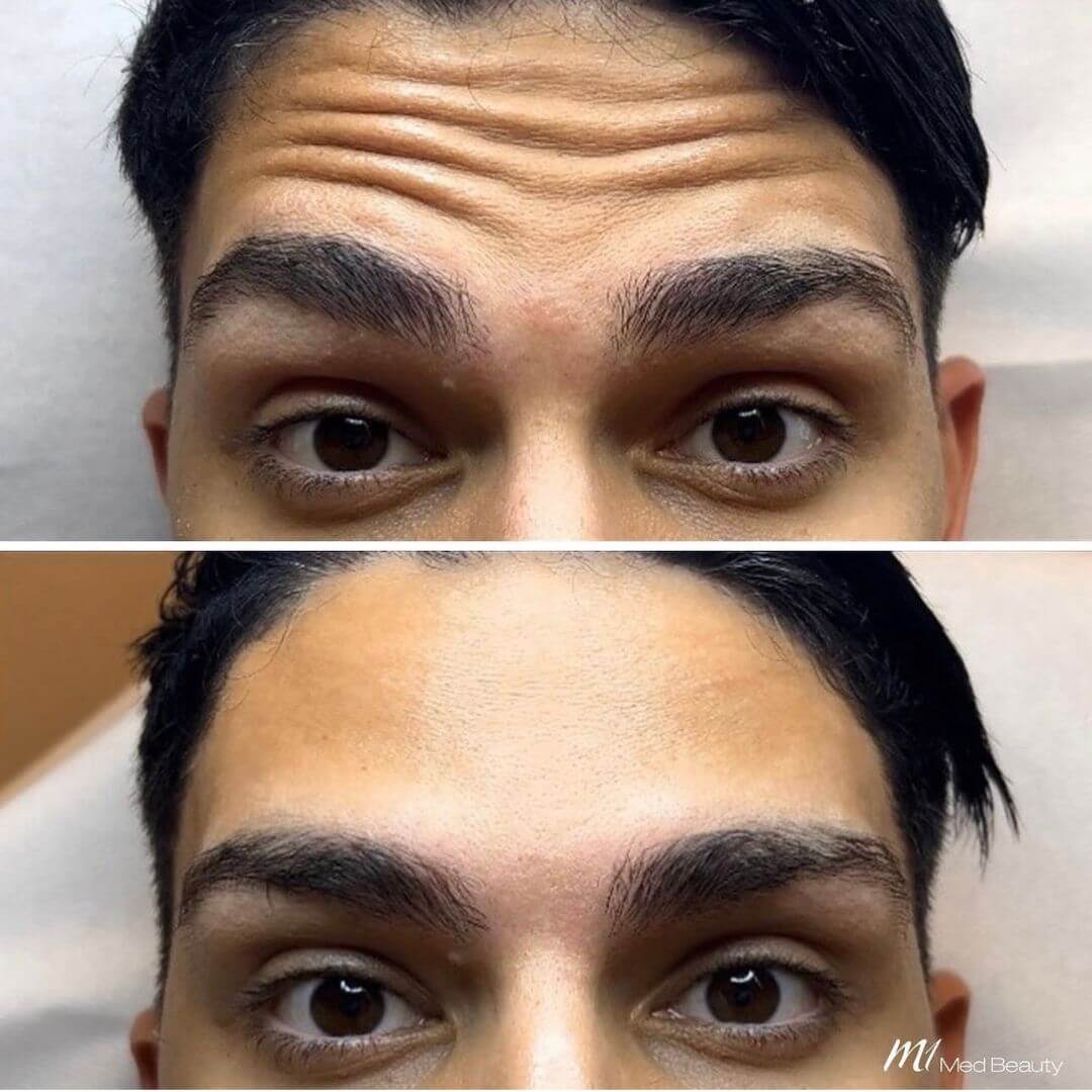 Forehead Wrinkles (2)