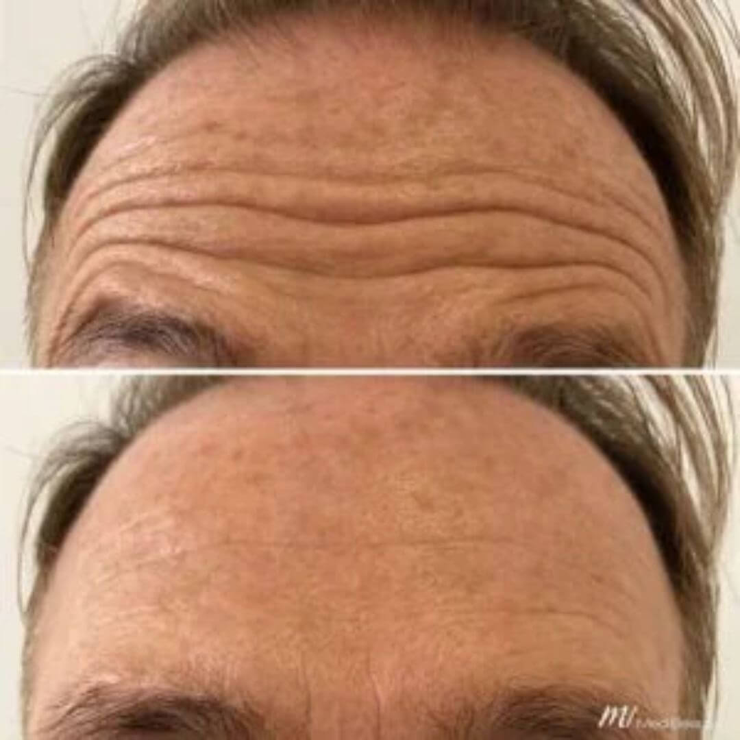 Forehead Wrinkles (4)