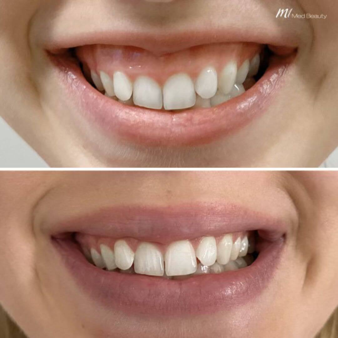 Gummy Smile (1) (1)