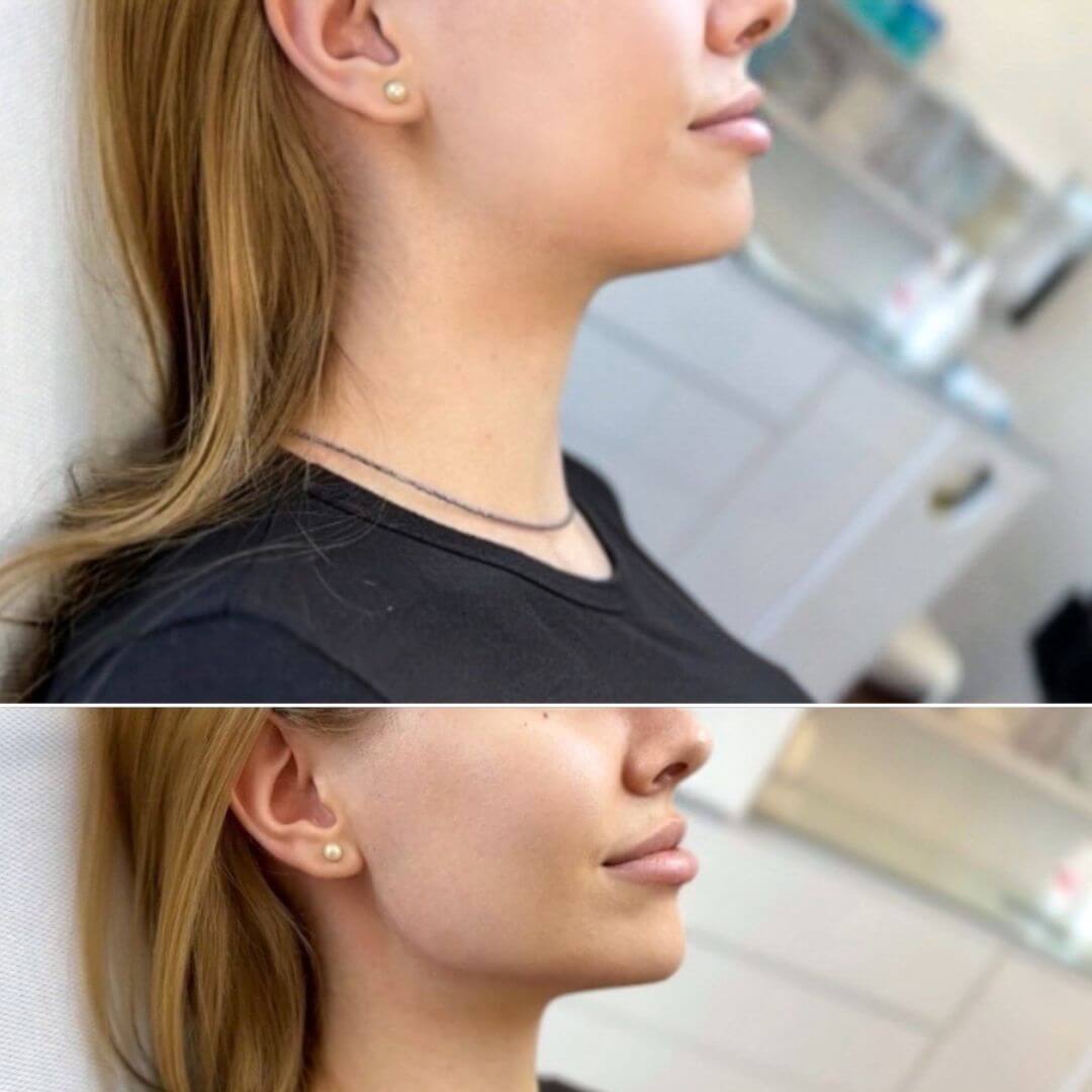 Jawline dermal filler M1 Beauty (10)