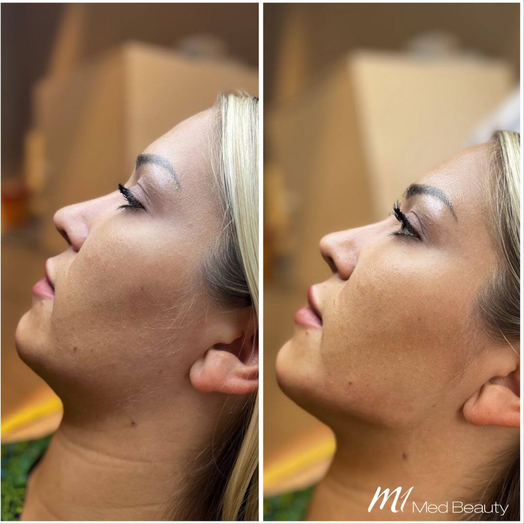 Jawline dermal filler M1 Beauty (11)