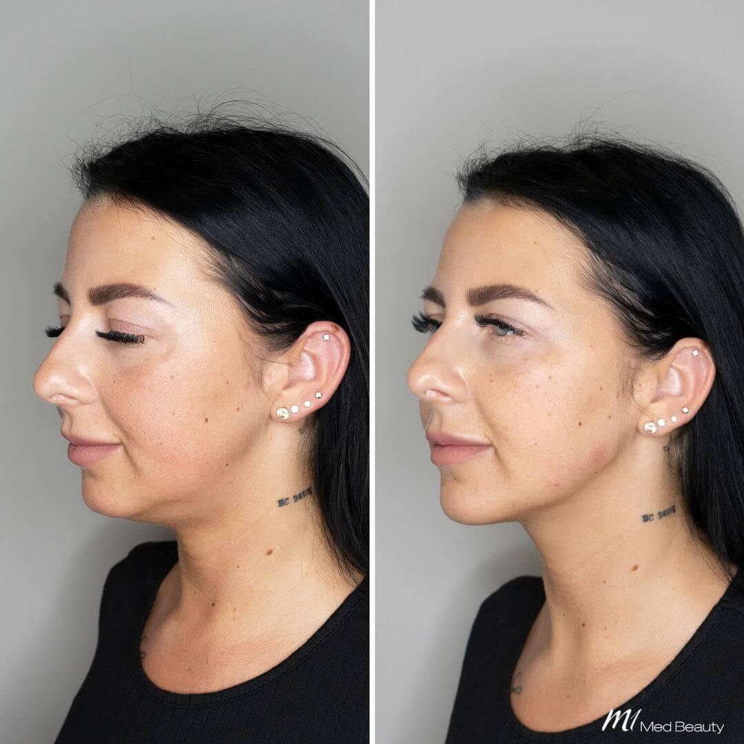 Jawline dermal filler M1 Beauty (5)