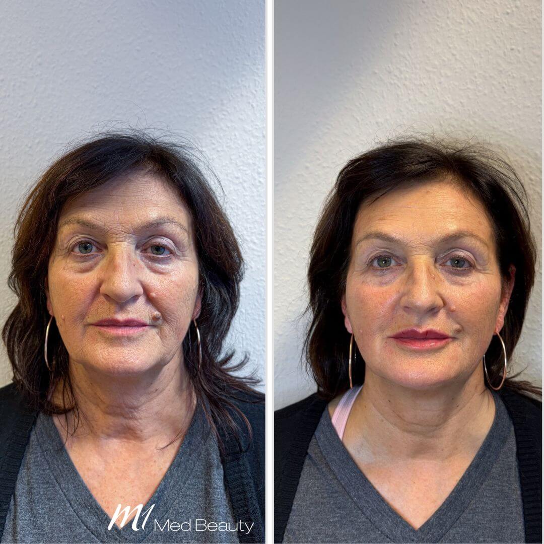 Jawline dermal filler M1 Beauty (6)