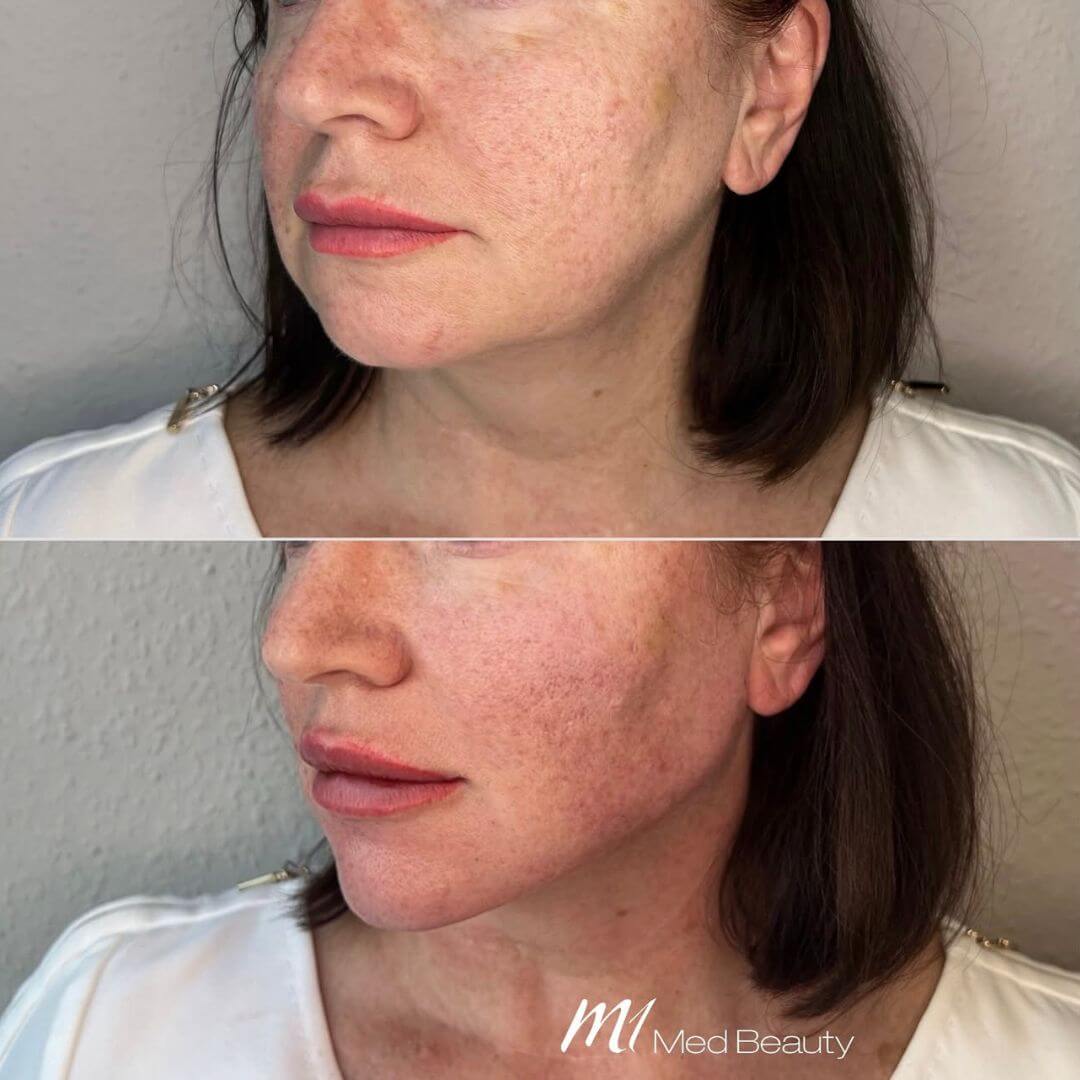 Jawline dermal filler M1 Beauty (7)