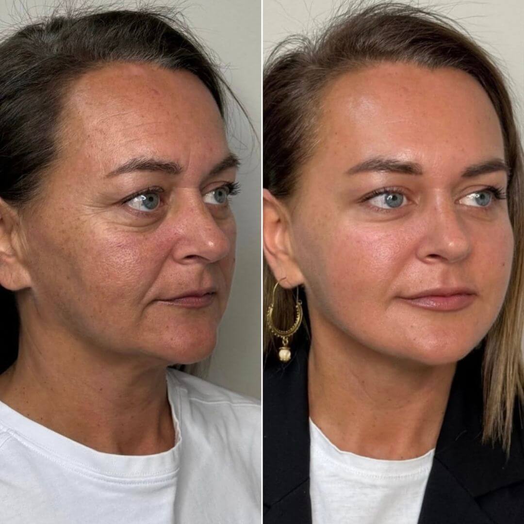 Jawline dermal filler M1 Beauty (8)