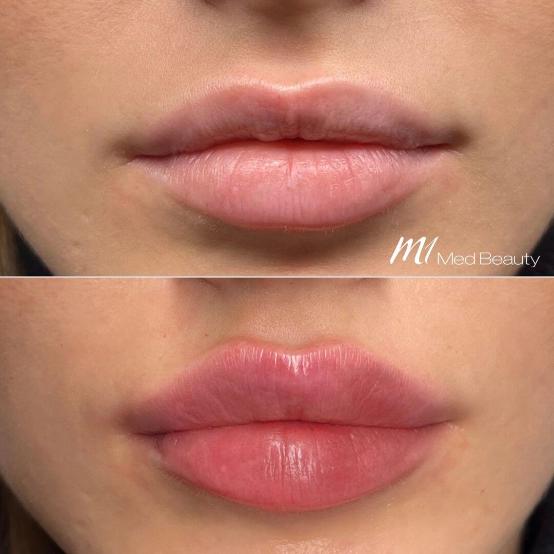 Lips dermal filler M1 Beauty (1)