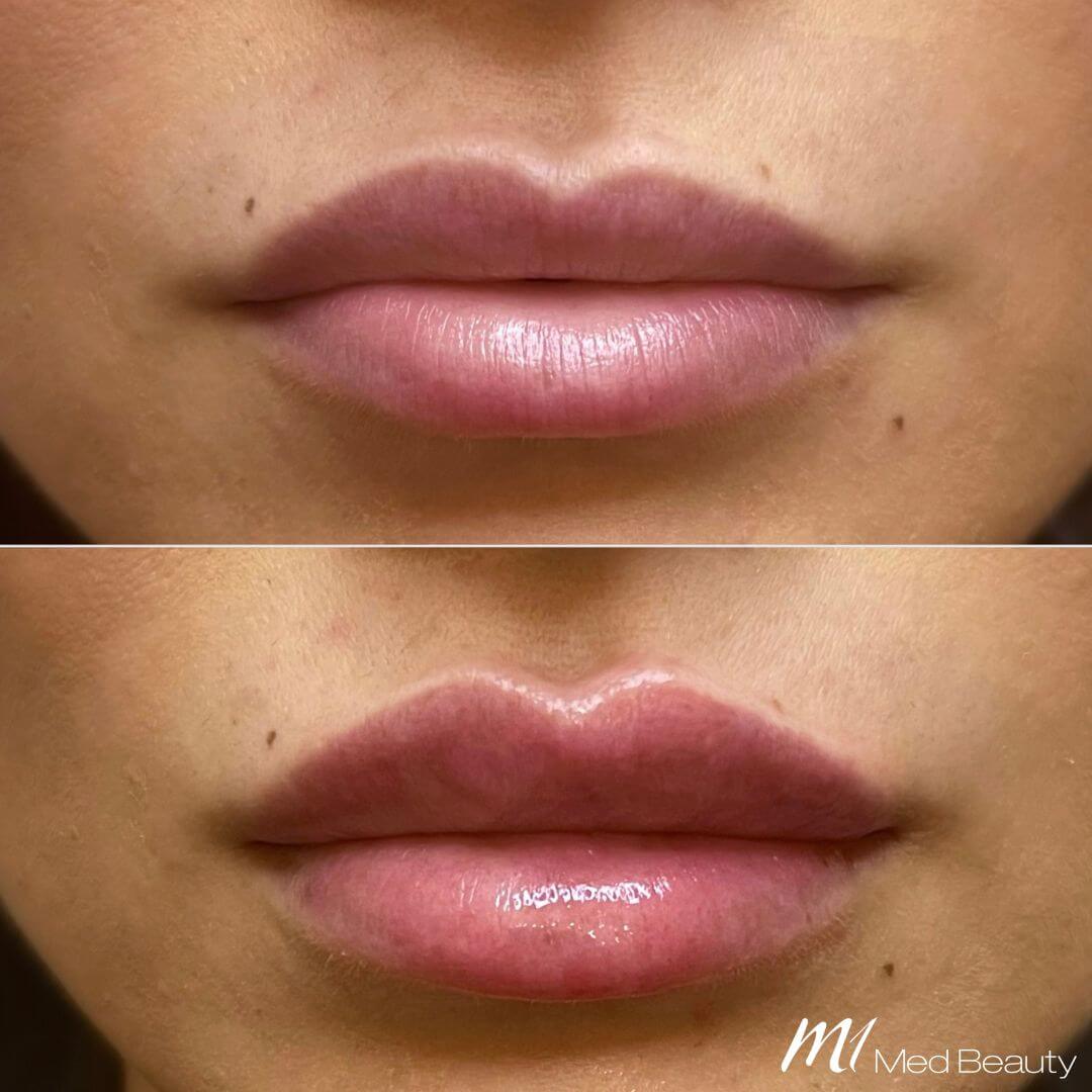 Lips dermal filler M1 Beauty (2)