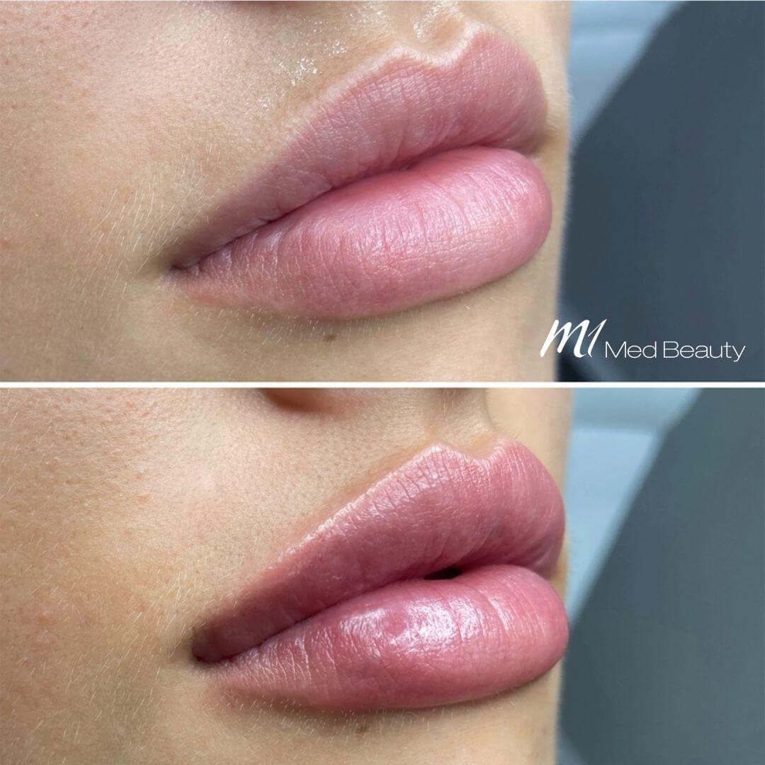 Lips dermal filler M1 Beauty (3)