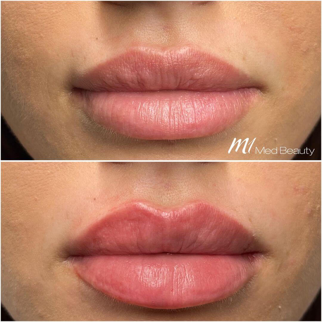 Lips dermal filler M1 Beauty (4)