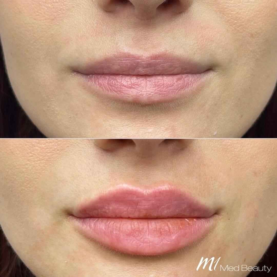 Lips dermal filler M1 Beauty (5)