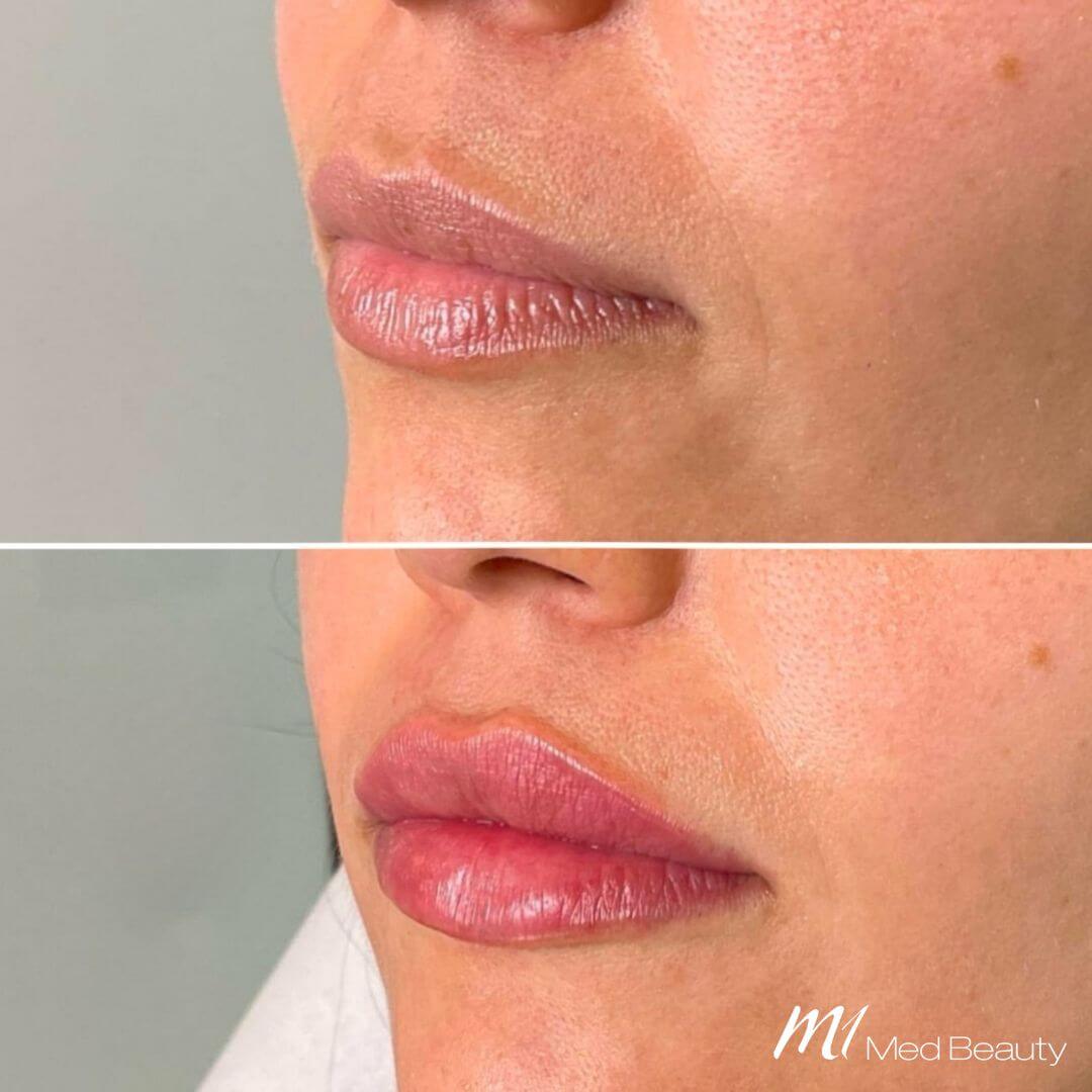 Lips dermal filler M1 Beauty (6)
