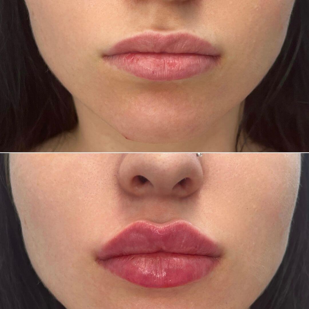Lips dermal filler M1 Beauty (7)