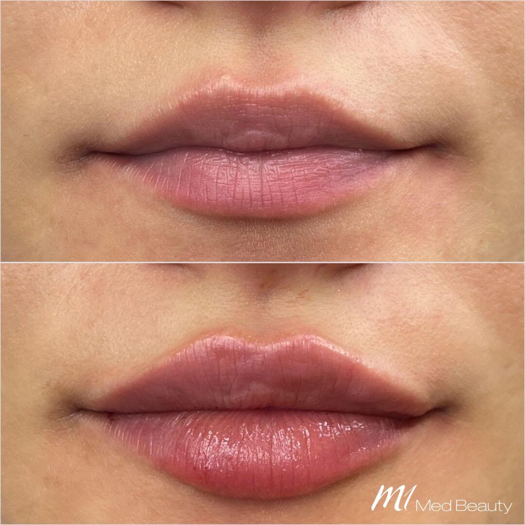 Lips dermal filler M1 Beauty (8)