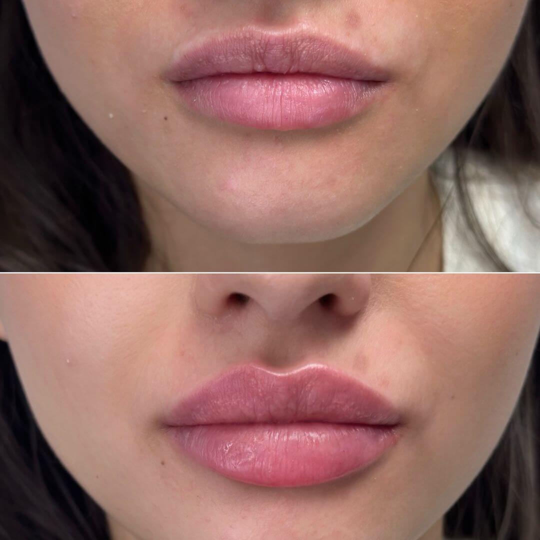 Lips dermal filler M1 Beauty (9)