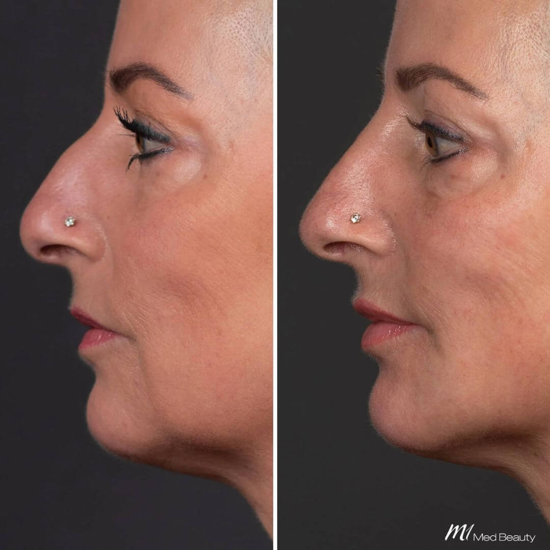 Marionette Lines dermal filler M1 Beauty (4)